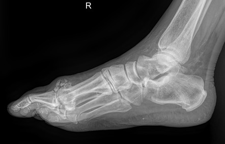 First metatarsophalangeal joint osteoarthritis | Image | Radiopaedia.org