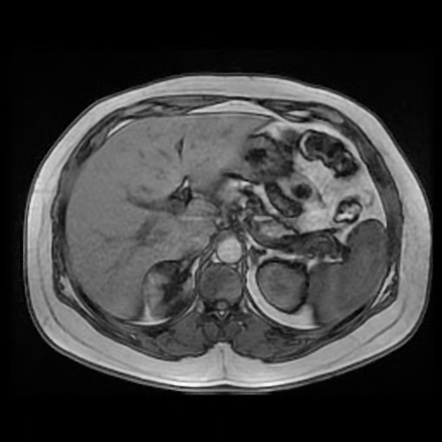 Adrenal myelolipoma | Radiology Reference Article | Radiopaedia.org