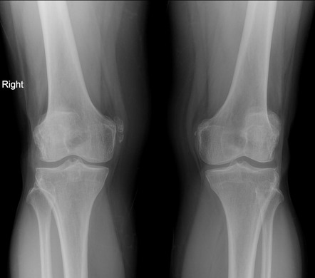 Bilateral Pellegrini-Stieda lesions | Radiology Case | Radiopaedia.org