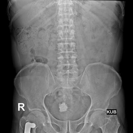 Urinary Bladder Calculus | Radiology Case | Radiopaedia.org