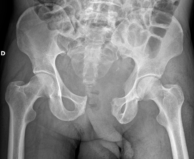 What are open book pelvic fractures?