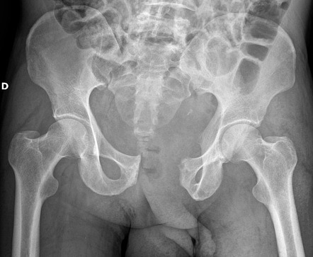 Open book pelvic injury - with follow-up | Radiology Case | Radiopaedia.org