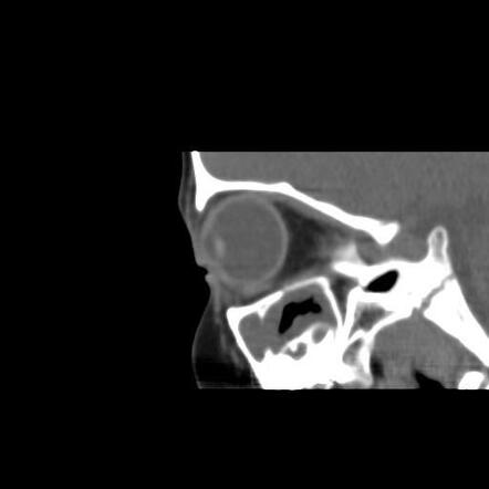 Dermoid cyst of the eyelid | Image | Radiopaedia.org