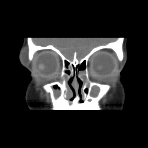 Dermoid cyst of the eyelid | Image | Radiopaedia.org