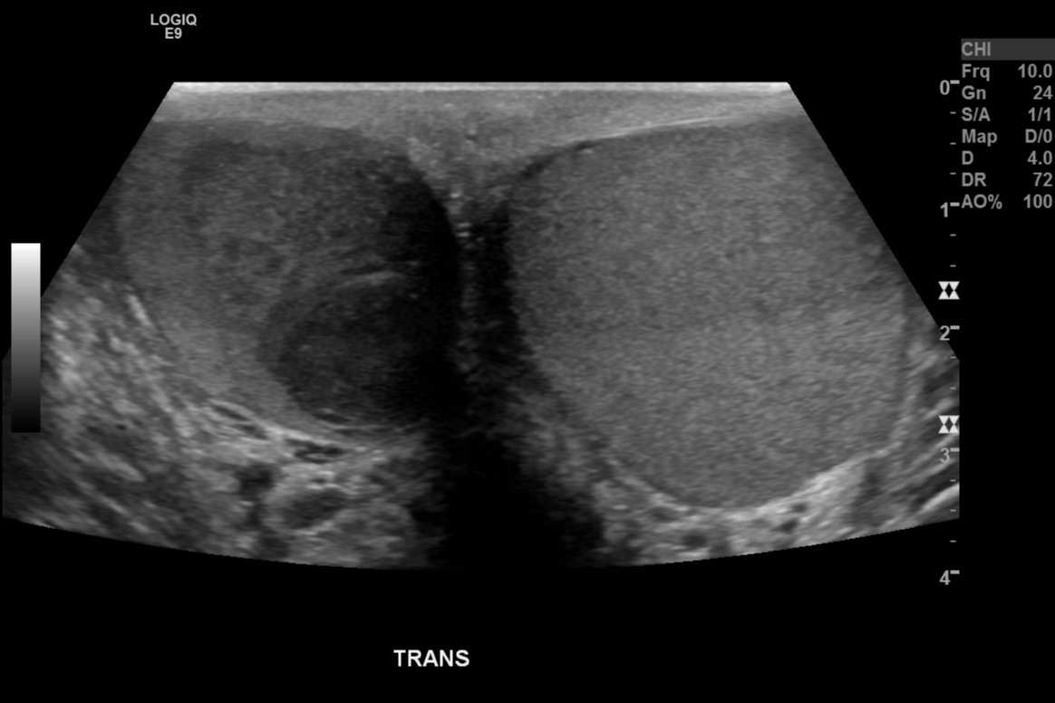 Testicular Seminoma Image