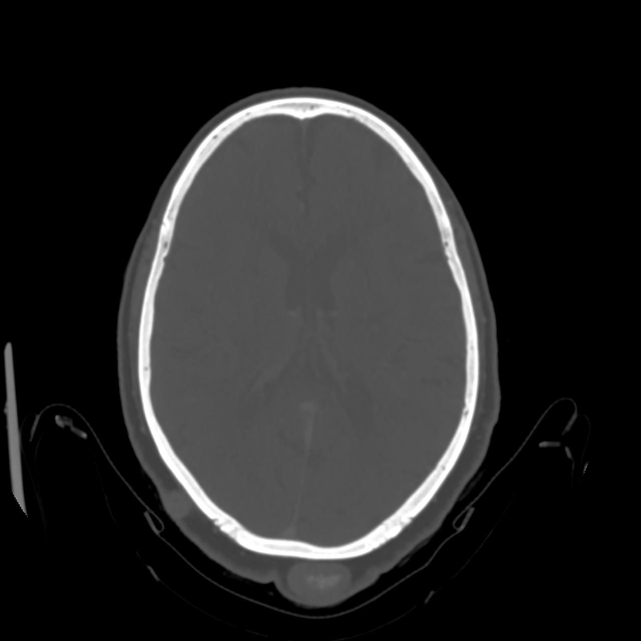 Trichilemmal Cysts Image