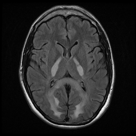 Heroin-induced leukoencephalopathy | Radiology Case | Radiopaedia.org