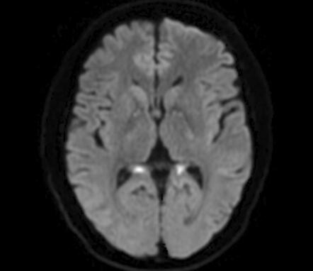 Cerebellar, hippocampal, and basal nuclei transient oedema with ...