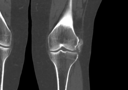 Lateral Collateral Ligament Calcification Radiology Reference Article Radiopaedia Org