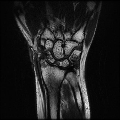 Wrist tenosynovial giant cell tumor - recurrence | Image | Radiopaedia.org