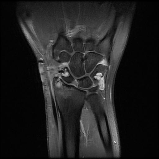 Wrist Tenosynovial Giant Cell Tumor Recurrence Image