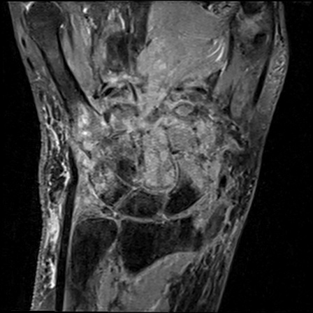 Osteomyelitis Radiopaedia