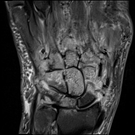 Hand septic arthritis and osteomyelitis (MRI) | Radiology Case ...