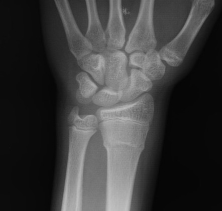 Incomplete fracture | Radiology Reference Article | Radiopaedia.org