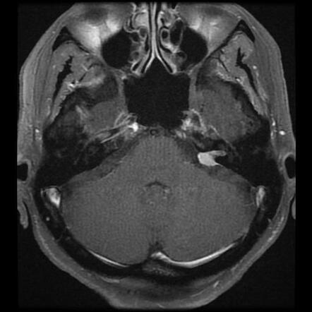 Meningioma - cerebellopontine angle | Radiology Case | Radiopaedia.org