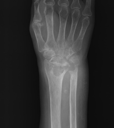 Tuberculous Arthropathy Of Wrist 