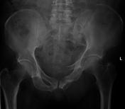 Open book pelvic injury, Radiology Reference Article