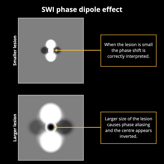 Susceptibility weighted imaging | Radiology Reference Article 