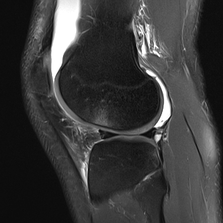 Anterior cruciate ligament rupture with Wrisberg rip | Radiology Case ...