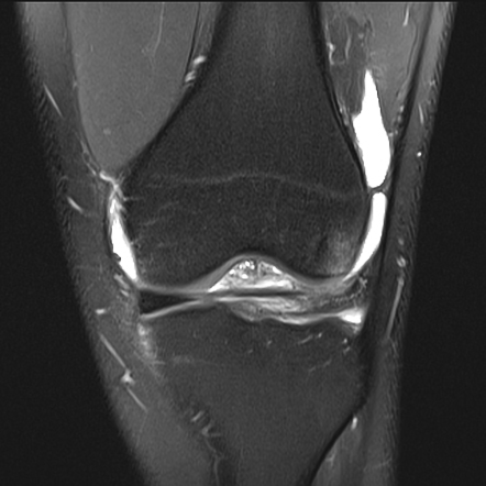 Anterior cruciate ligament rupture with Wrisberg rip | Image ...