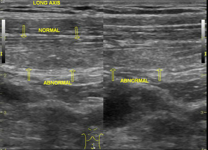 Rectus abdominis muscle strain | Image | Radiopaedia.org