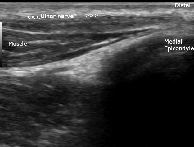 Ulnar nerve injury | Image | Radiopaedia.org