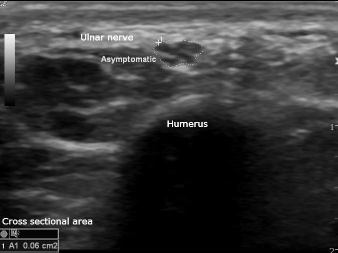 Ulnar nerve injury | Image | Radiopaedia.org