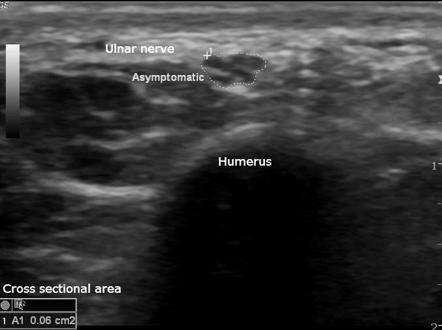 Ulnar Nerve Injury 