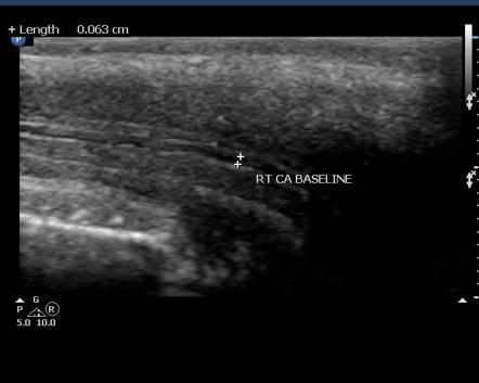 Sildenafil citrate induced penile Doppler Radiology Reference