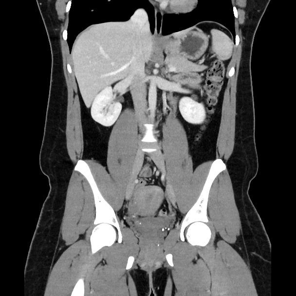 Abdominal Wall Desmoid Tumor Image 9888