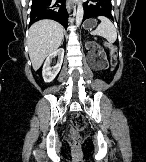 Postoperative severe hydroureteronephrosis | Image | Radiopaedia.org