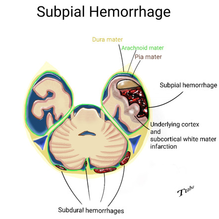 Subpial haemorrhage | Radiology Reference Article | Radiopaedia.org