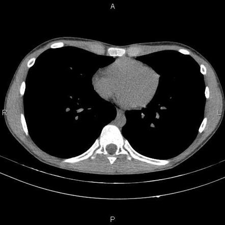 Mild pectus excavatum | Radiology Case | Radiopaedia.org