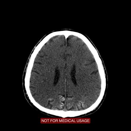 hypoxic encephalopathy ischemic radiopaedia radiology