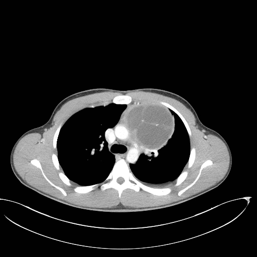 Reporting Of Covid19 Chest Ct Findings Radiopaediaorg