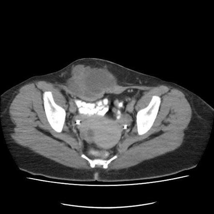 Endometriosis In Abdominal Wall Radiology Case Radiopaedia Org