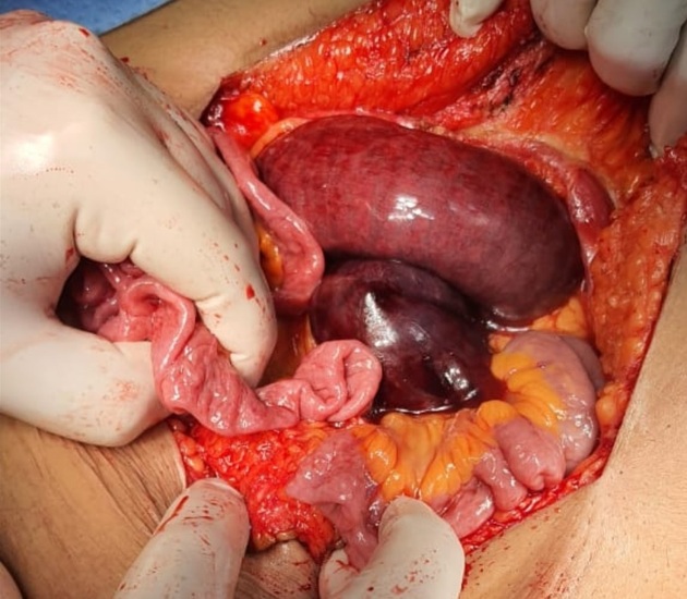 Closed loop obstruction Radiology Reference Article