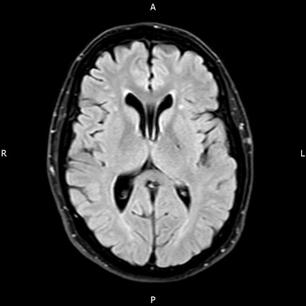 Transient global amnesia | Image | Radiopaedia.org