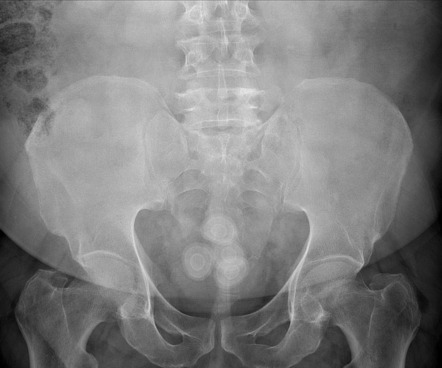 Urinary Bladder Calculi | Radiology Case | Radiopaedia.org