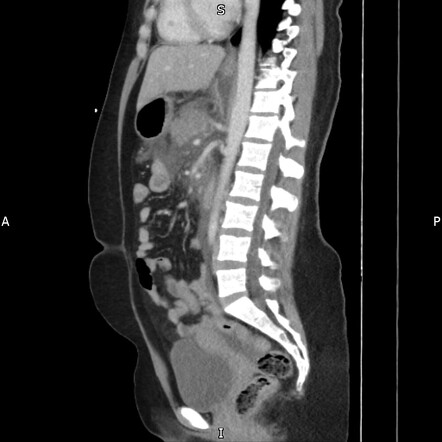 Acute interstitial edematous pancreatitis | Image | Radiopaedia.org