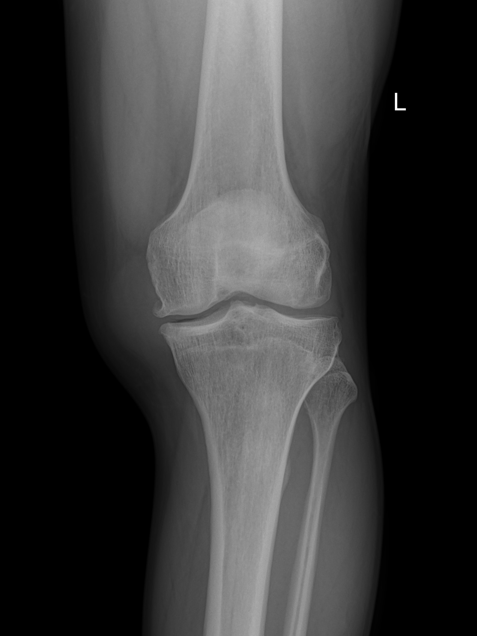 Parameniscal cyst | Image | Radiopaedia.org