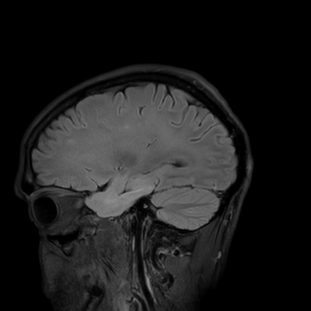 West Nile virus encephalitis | Radiology Case | Radiopaedia.org