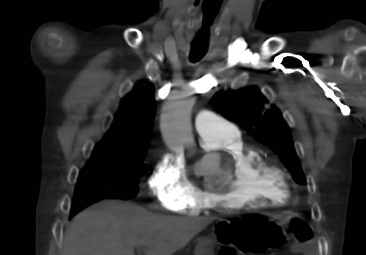 Right sinus of Valsalva aneurysm | Image | Radiopaedia.org