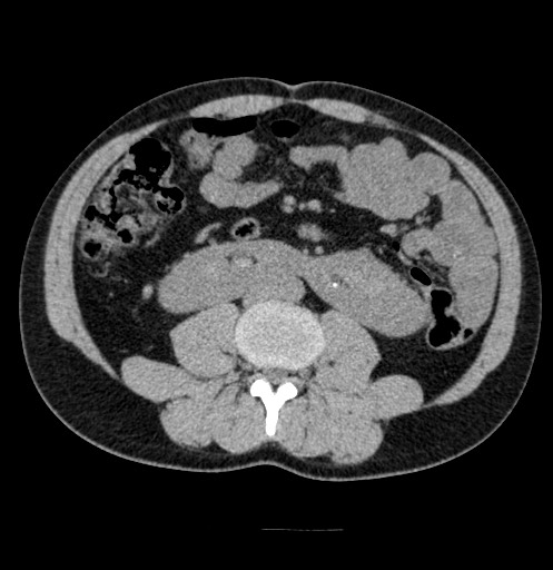 Horseshoe Kidney With Bilateral Renal Stones And Hydronephrosis Image