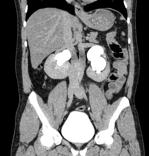 horseshoe-kidney-with-bilateral-renal-stones-and-hydronephrosis-image