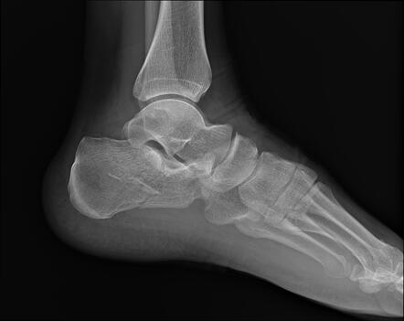 Calcaneal fracture | Radiology Case | Radiopaedia.org