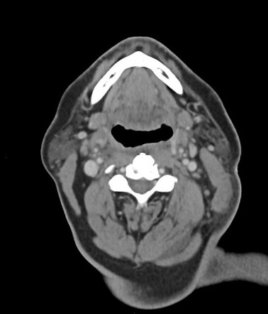 Sternoclavicular abscess and osteomyelitis | Radiology Case ...