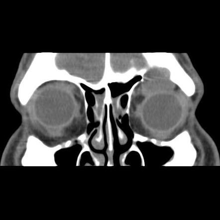 Frontal sinus mucocele | Radiology Case | Radiopaedia.org