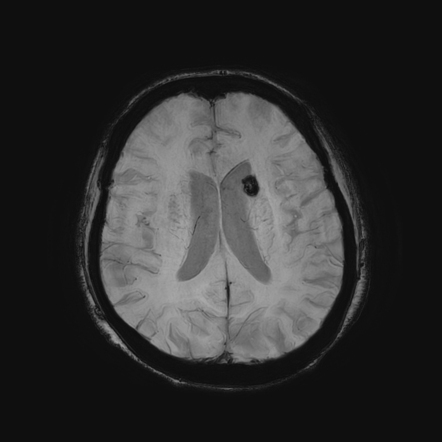 Cavernoma - caudate nucleus | Radiology Case | Radiopaedia.org