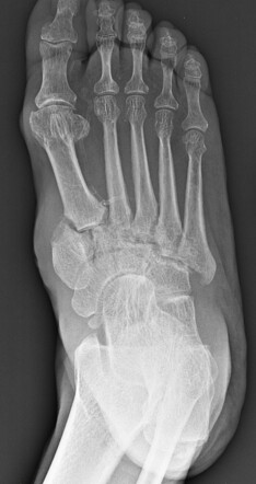 Charcot foot - homolateral Lisfranc dislocation | Radiology Case ...